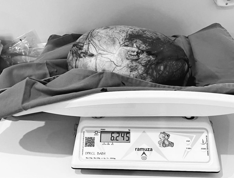 Jovem retira cisto de 6,2 kg do ovário em cirurgia de urgência no Hospital de Guarabira