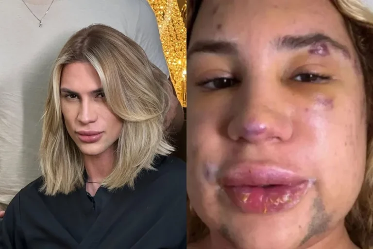 Influenciador morre após complicações de procedimento estético