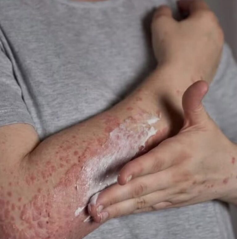 Alto custo faz Ministério da Saúde descartar vacina contra herpes-zóster no SUS